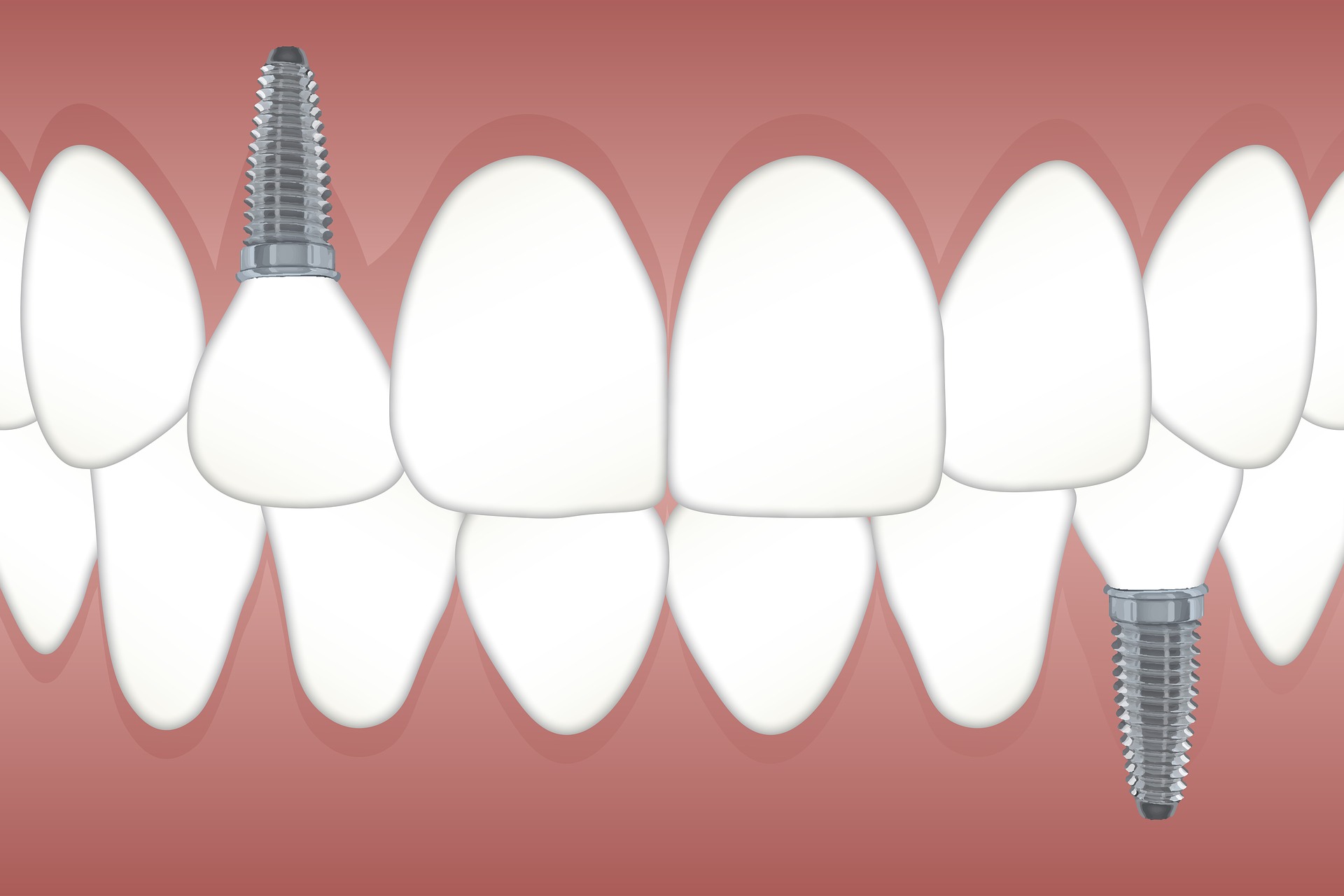 Jak wygląda schemat implantów dentystycznych