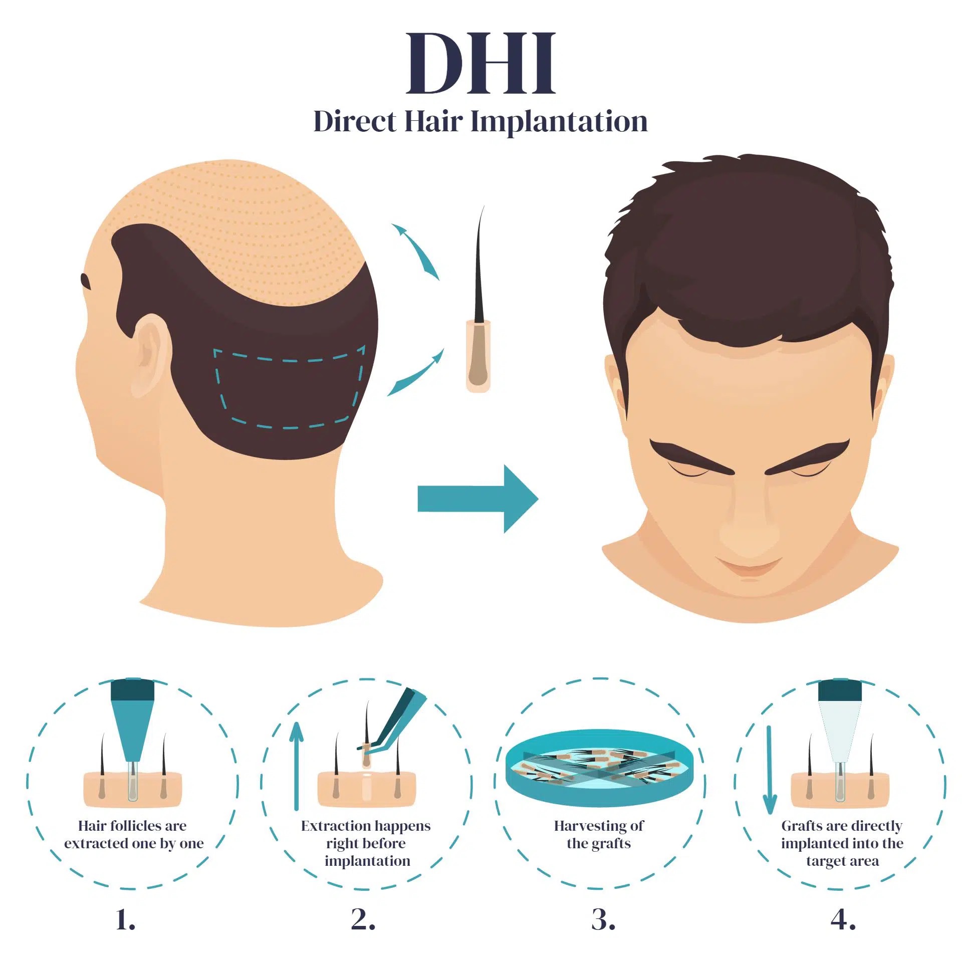 Przeszczep włosów DHI w Turcji