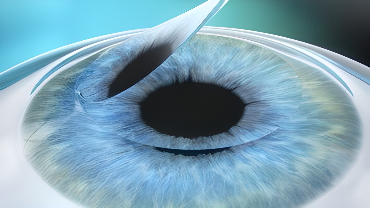 Schemat oka podczas zabiegu Lasik