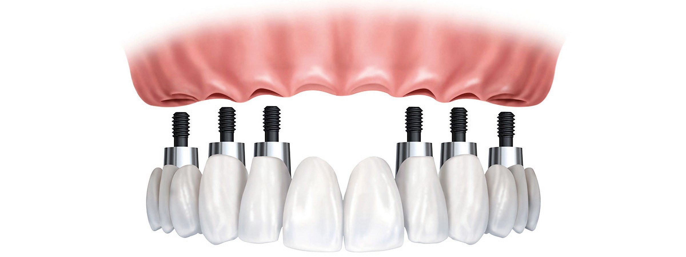 Uzyskanie implantów dentystycznych w Turcji