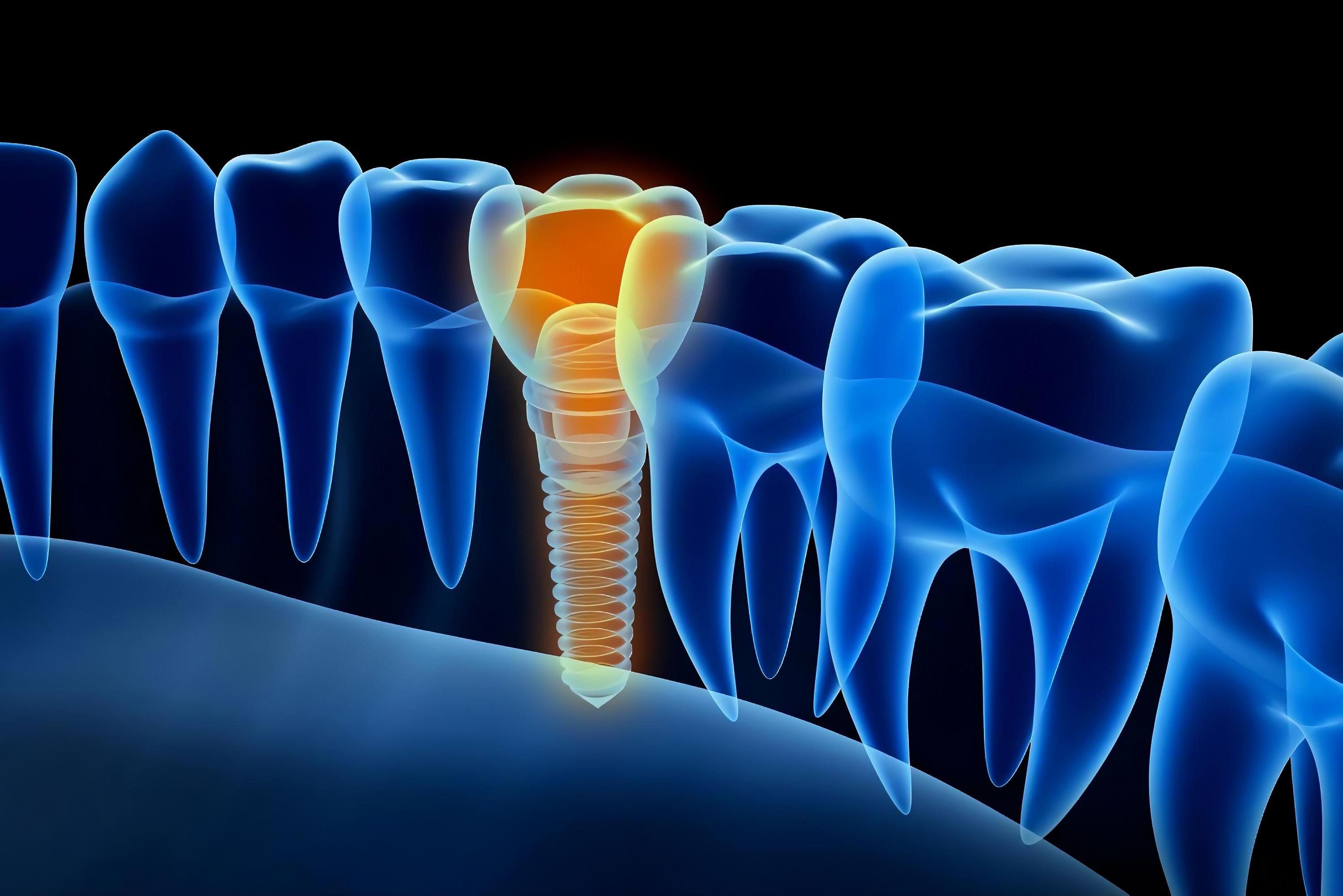 Остеопороз и зубные имплантаты