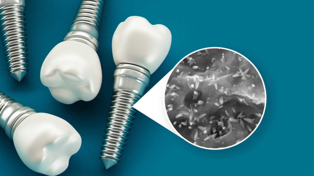 зубные имплантаты наноструктурные