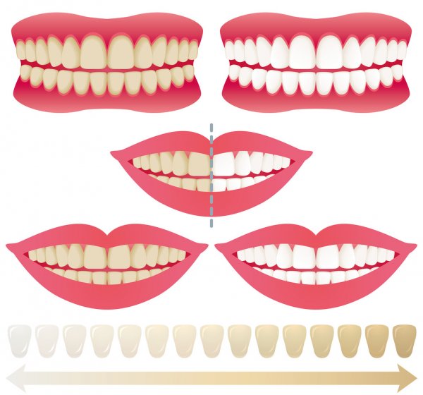 Skala kolorów dla wybielania zębów