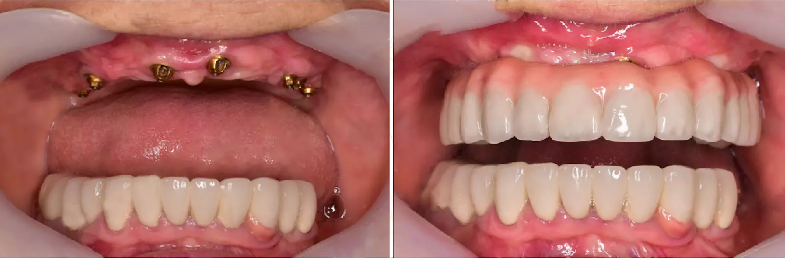 Wszystkie na 6 implantów dentystycznych w Turcji