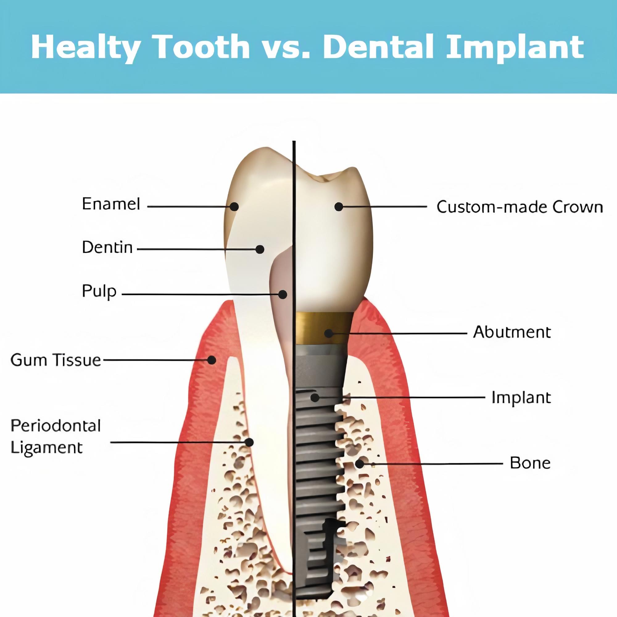 zdrowe zęby a implanty