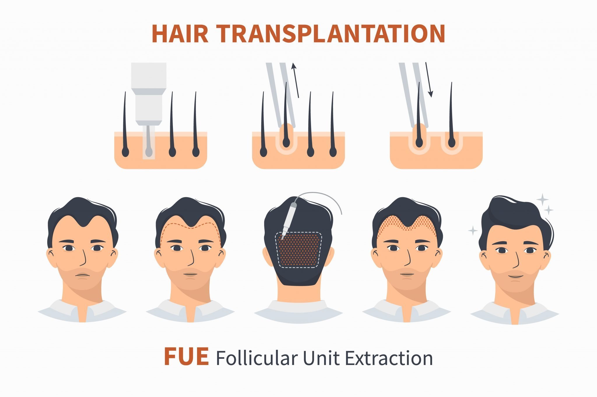 Przeszczep włosów metodą FUE
