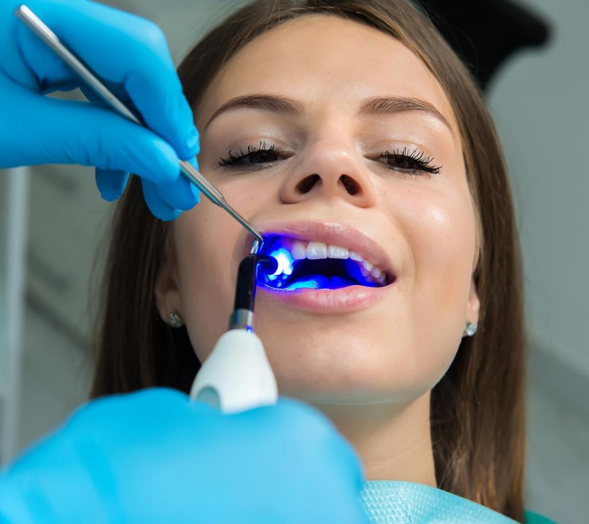 Wypełnienie stomatologiczne w klinice stomatologicznej Granddent w Odessie Ukraina