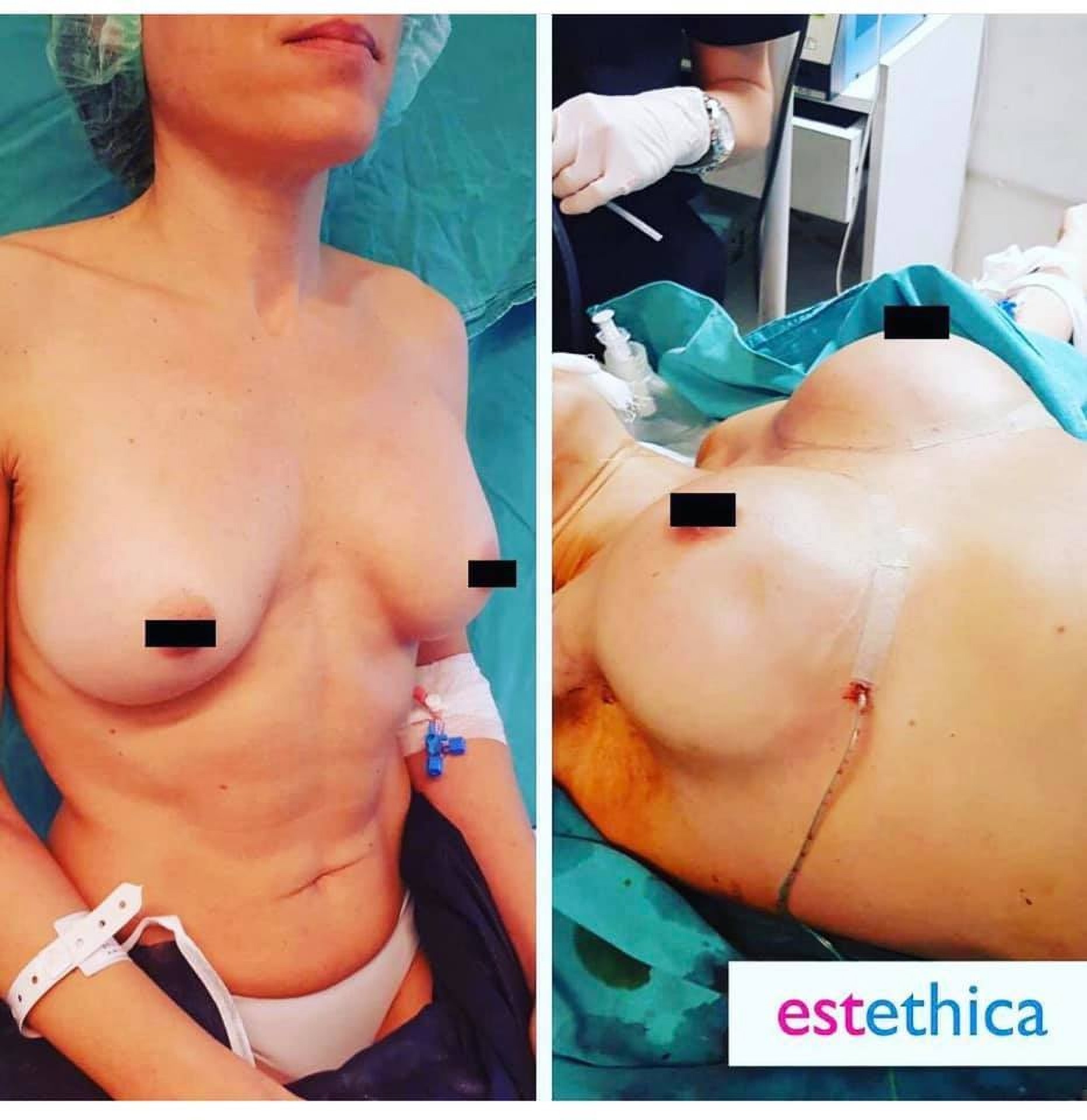 Powiększanie piersi w Istambule w Klinice Estethica