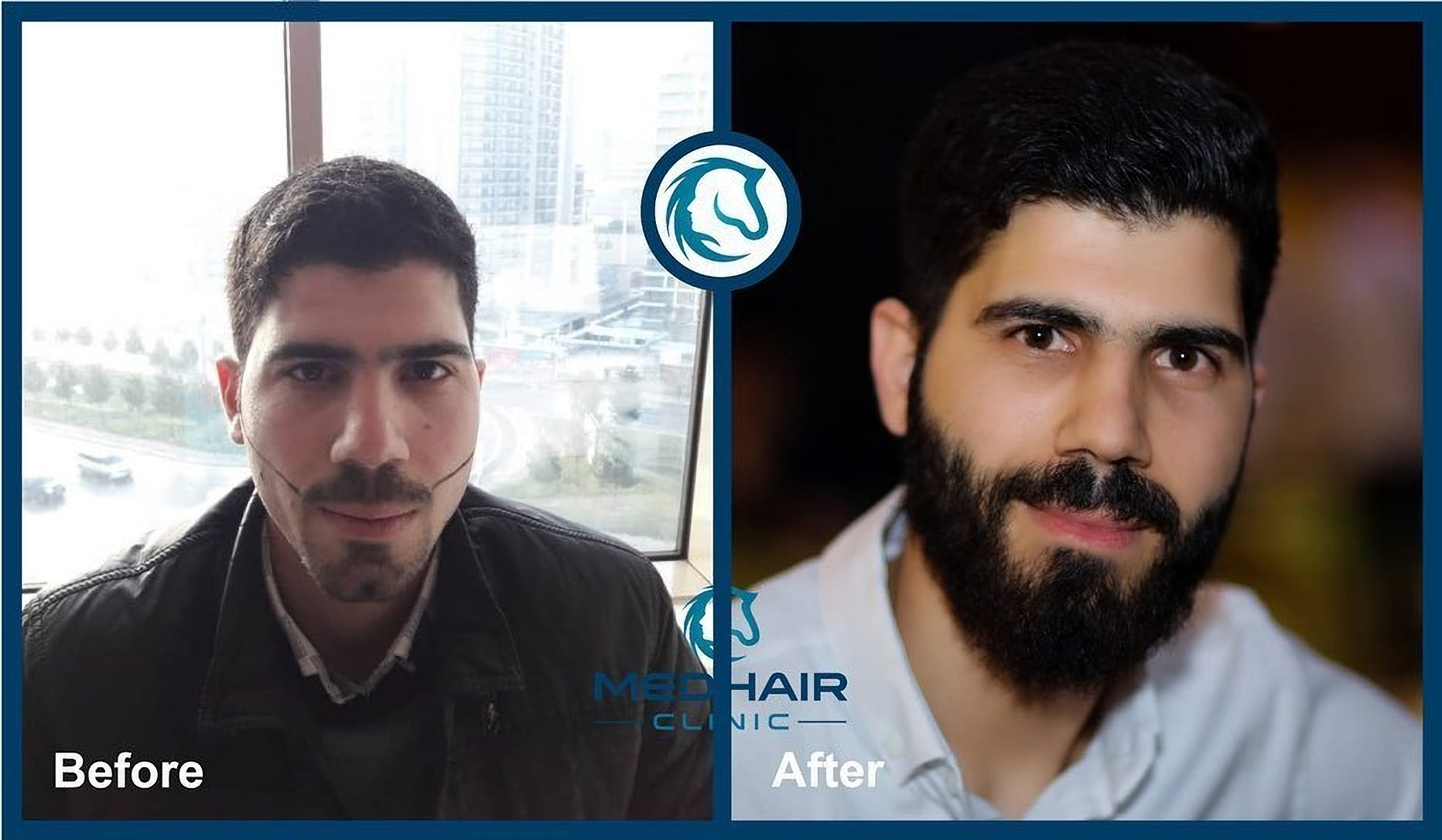 Przeszczep włosów do brody przed i po