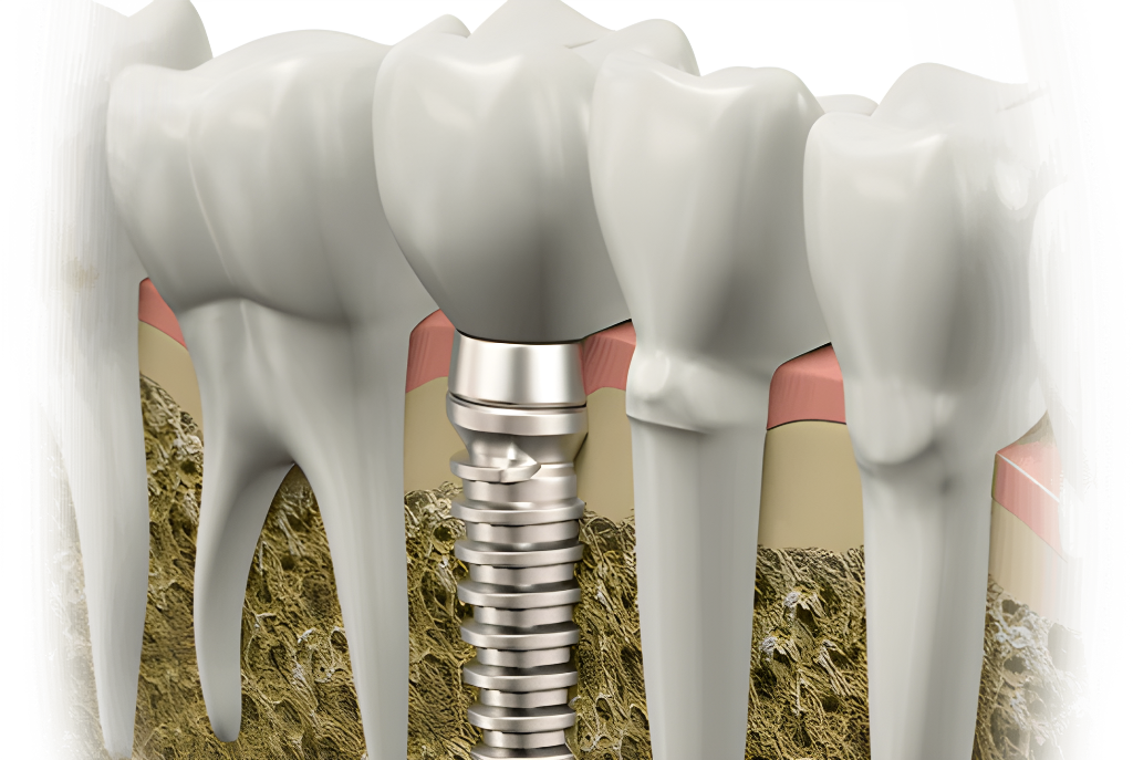 Izraelskie implanty stomatologiczne
