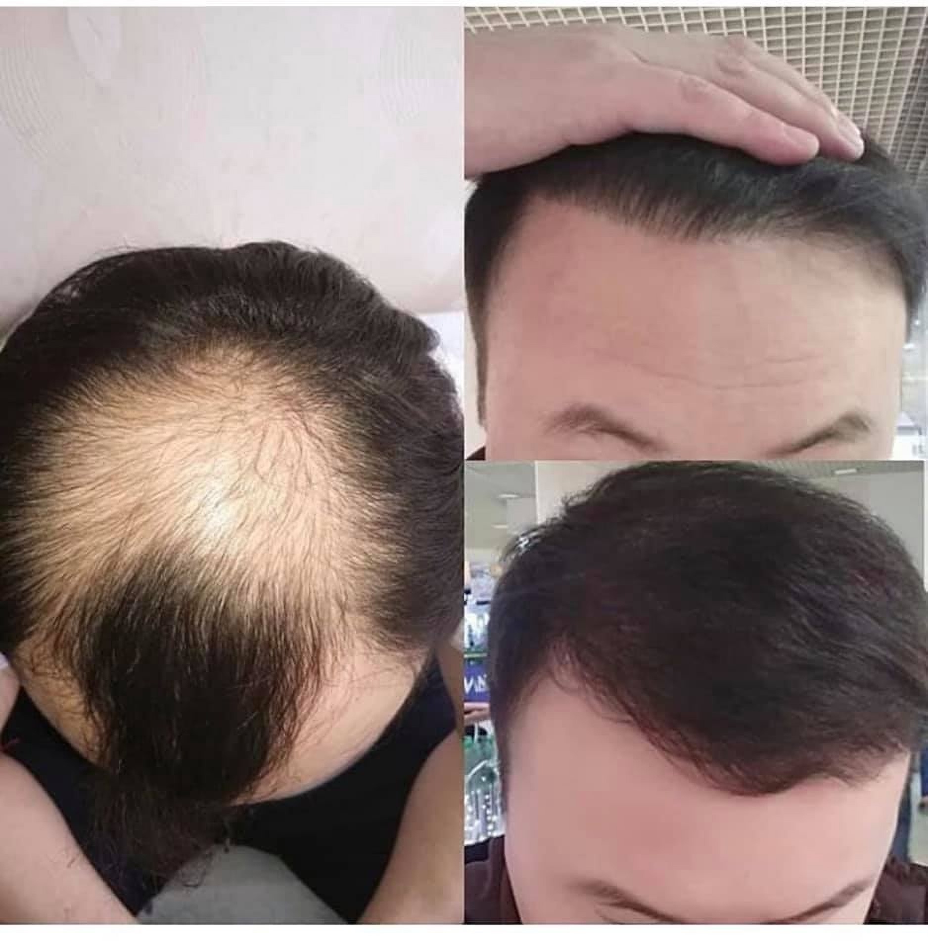 Przed i po przeszczepie włosów w Istambule w Klinice Estethica