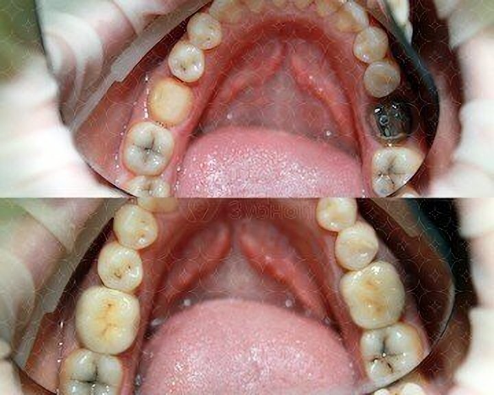 Implantacja w klinice Your Dentist w Odessie Ukraina