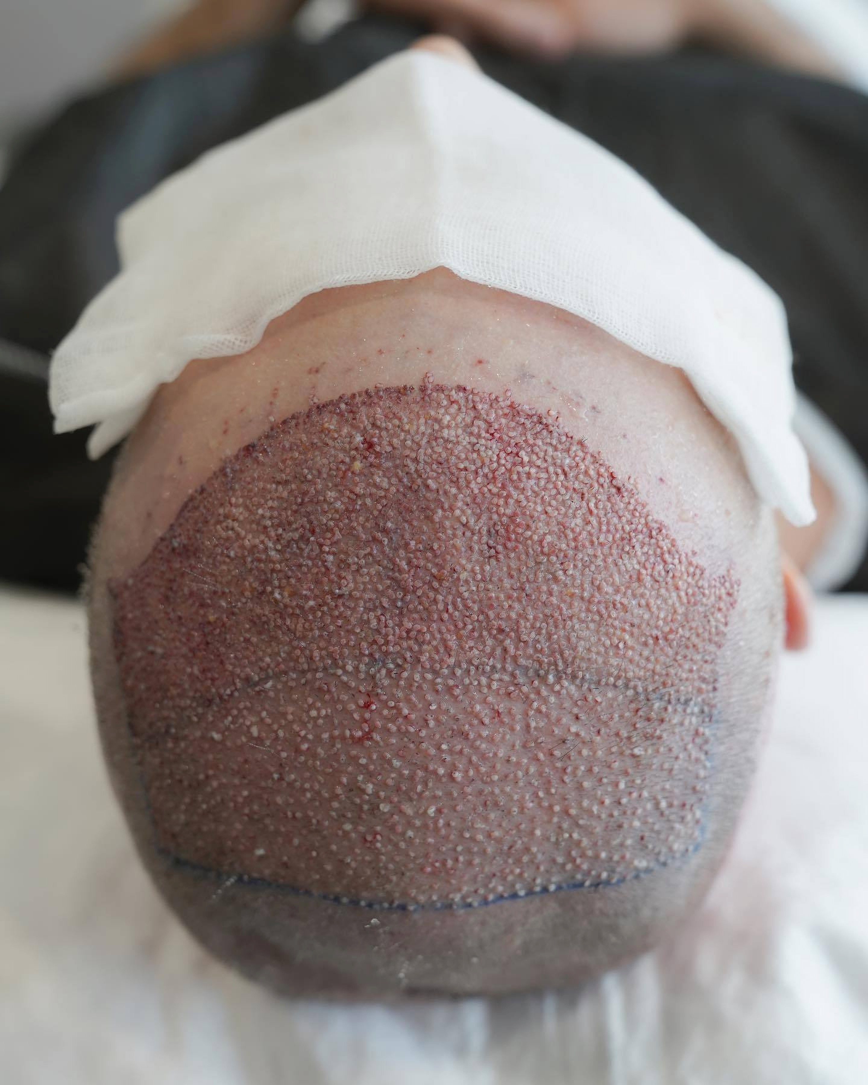 Skóra głowy po przeszczepie włosów w Turcji