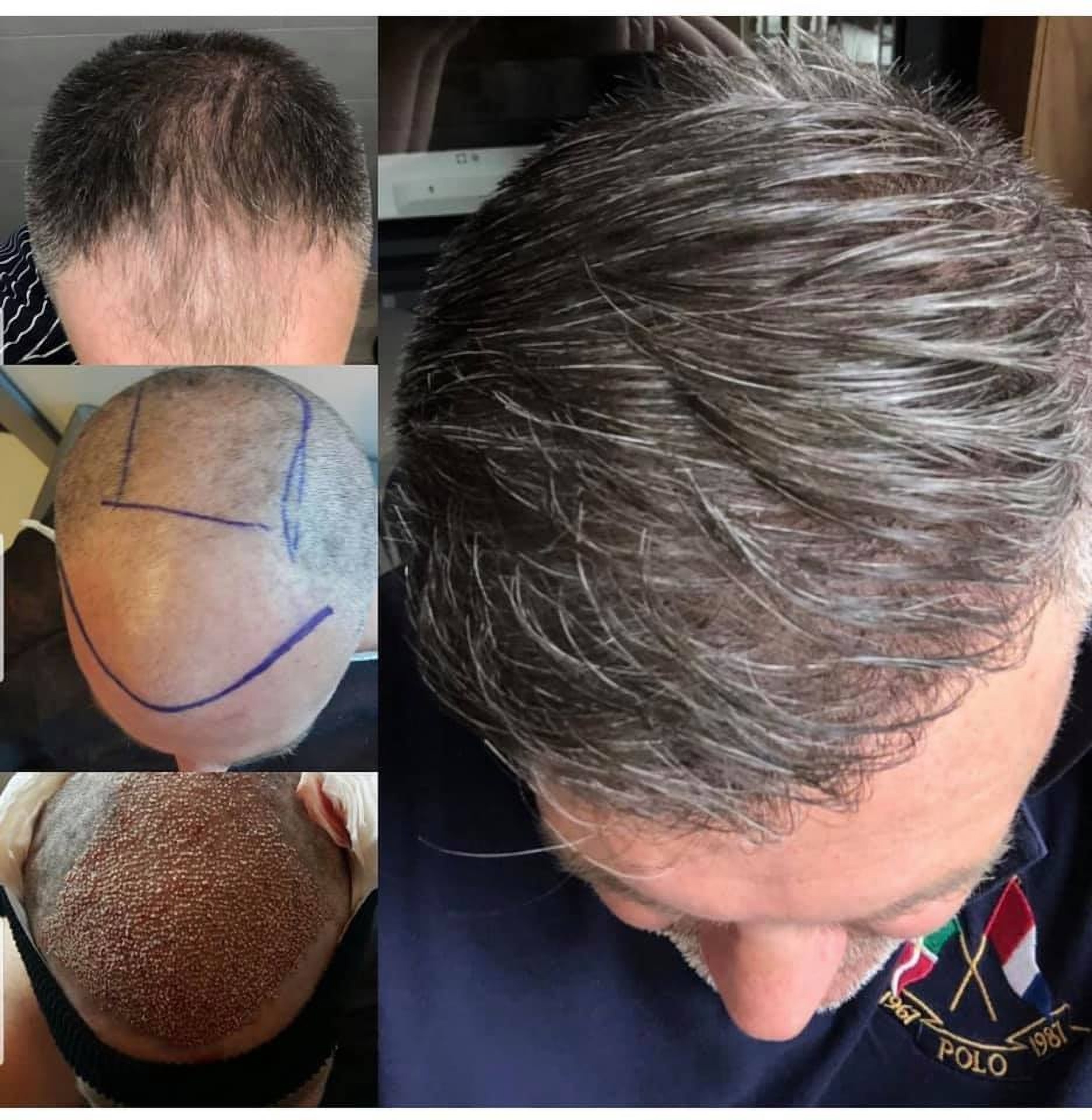 Wyniki przeszczepu włosów w Istambule w Klinice Estethica