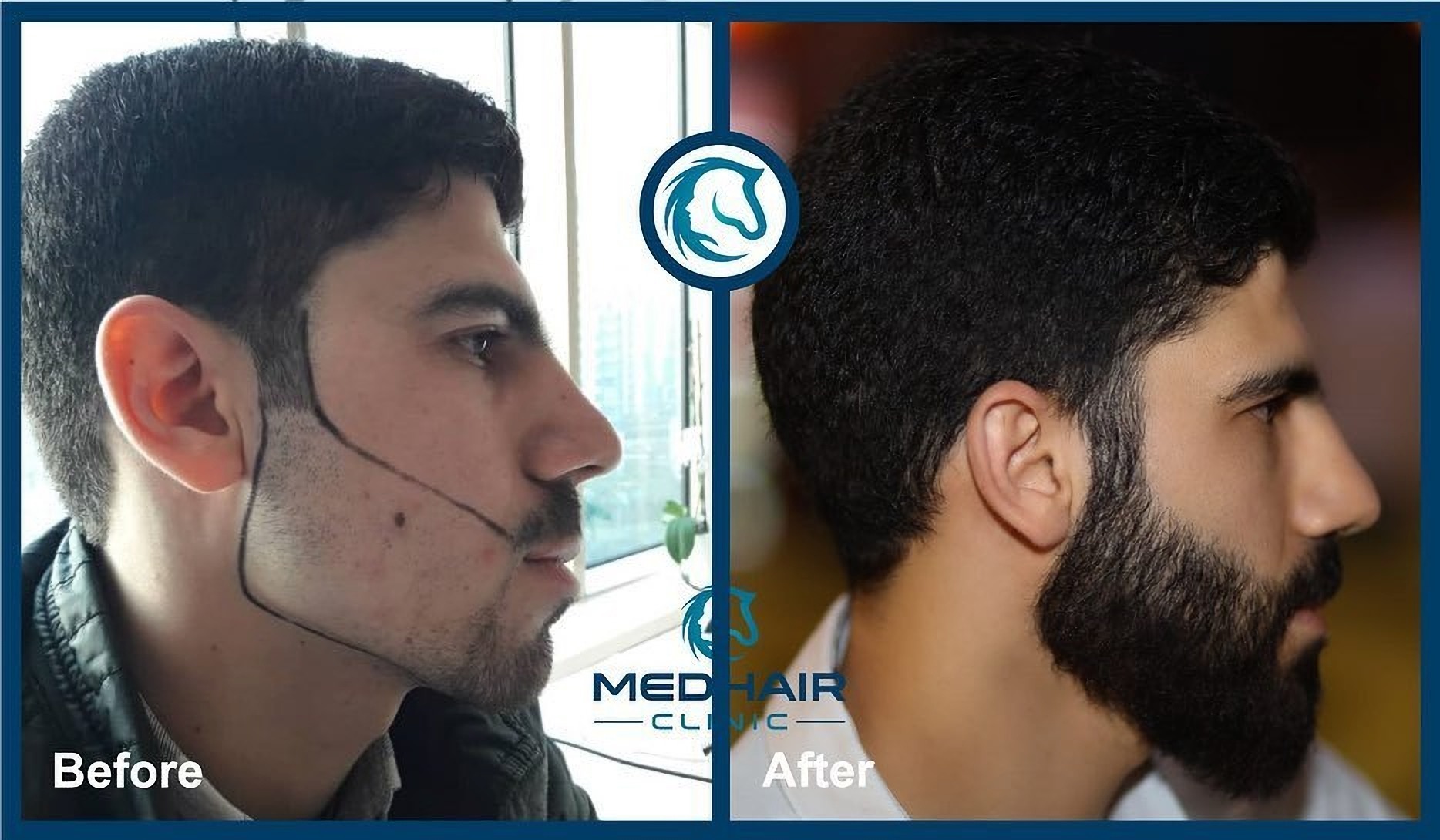 Przeszczep włosów dla brodaczy w Turcji