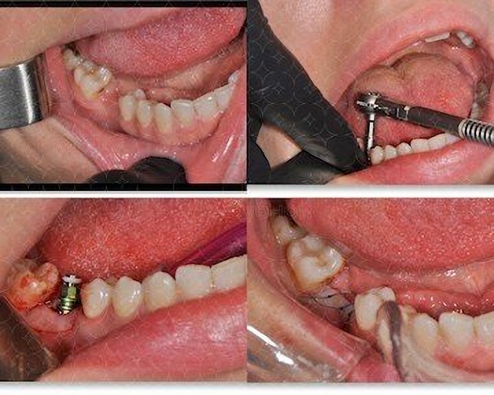 Instalacja implantów stomatologicznych w Twojej klinice w Odessie na Ukrainie