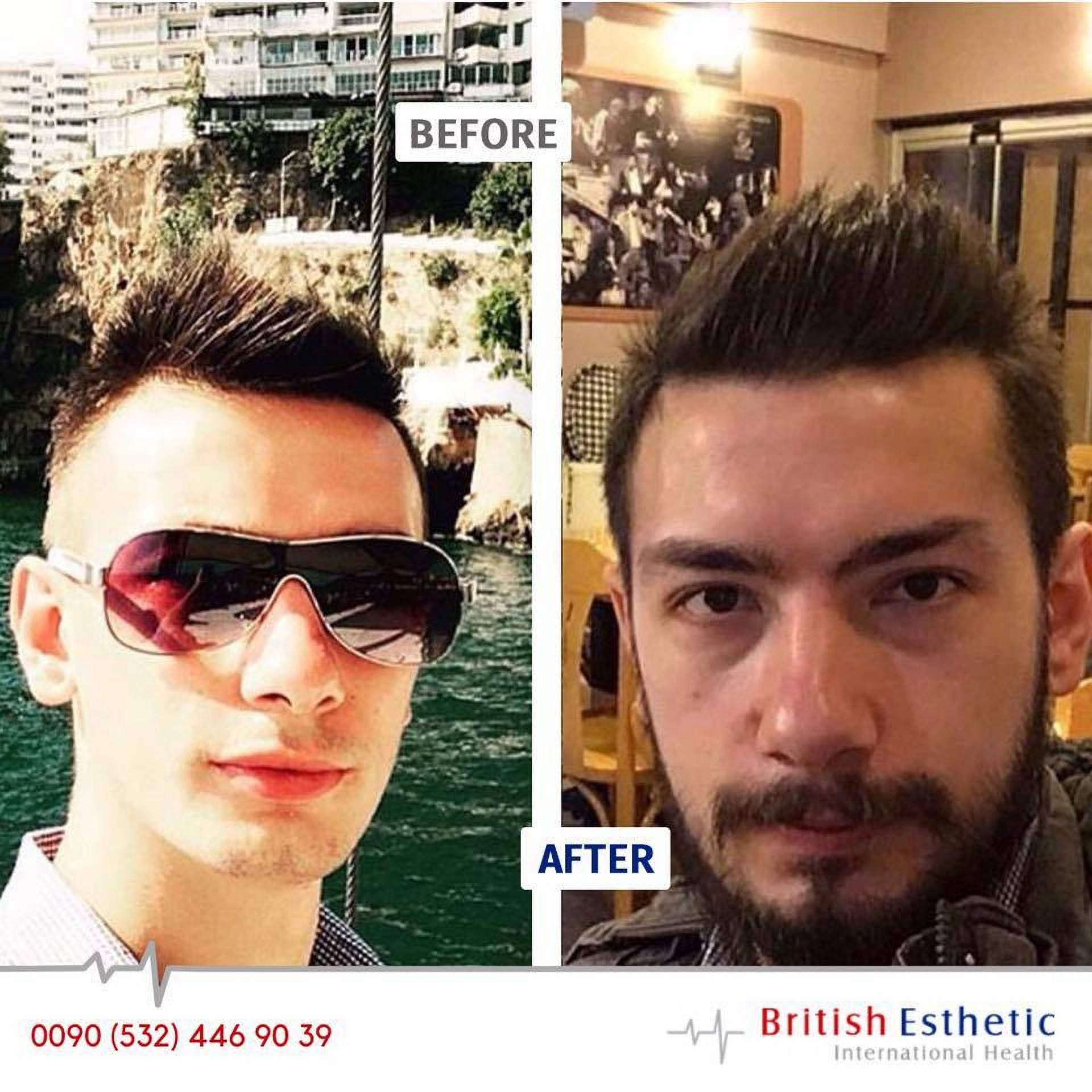 Przeszczep włosów i brody w brytyjskich klinikach Estetik w Stambule